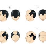 norwood_scale