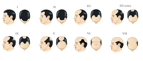 Hair Loss men pattern