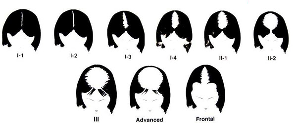 Hair Loss Women